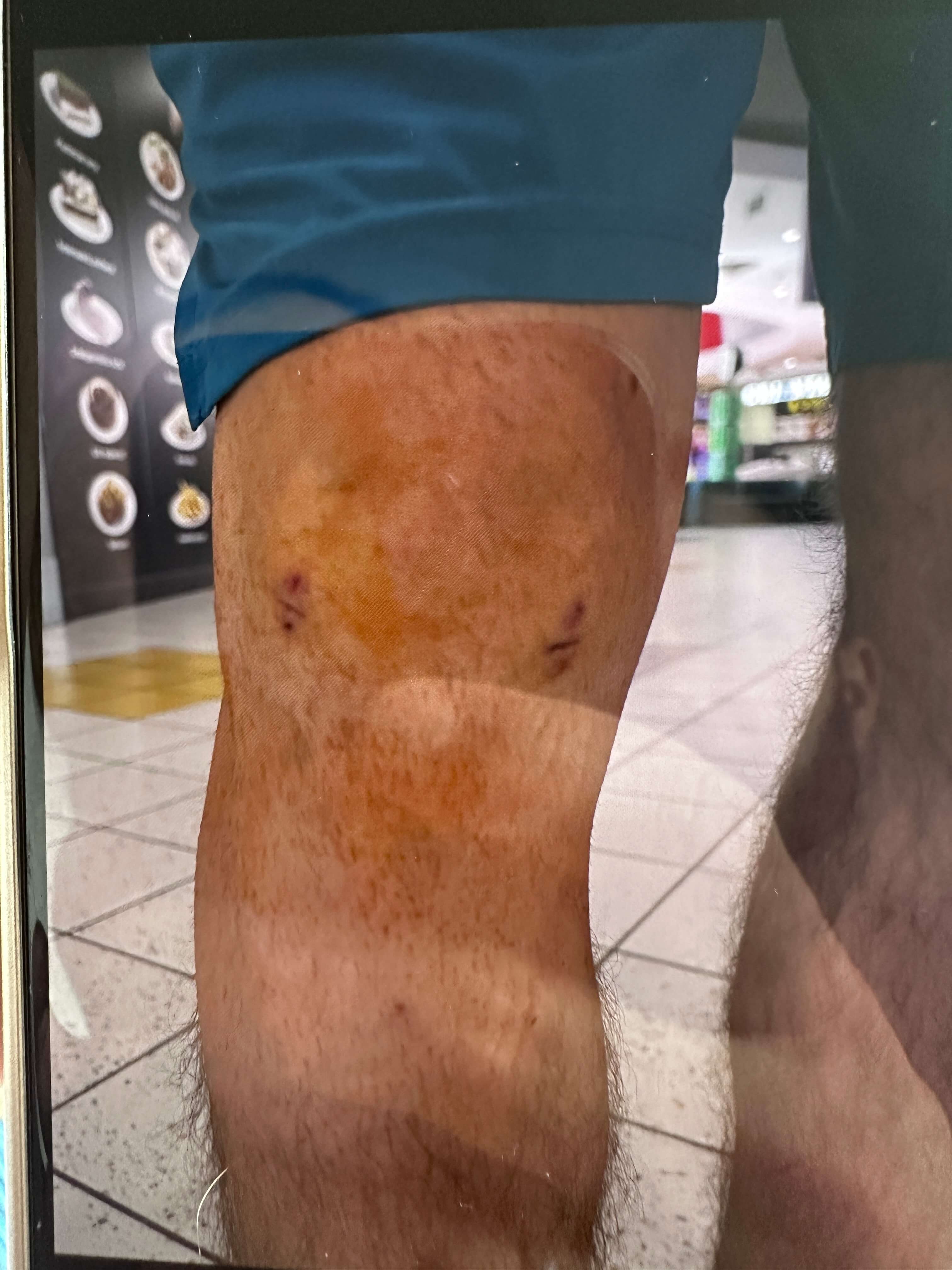 Jobb térd meniscus műtét utáni állapot
